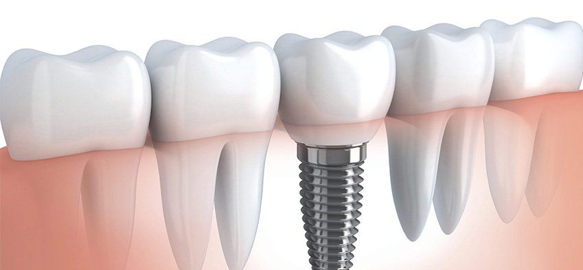 implante dental cajamarca